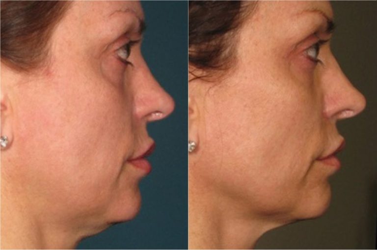 ultherapy-before-after-01