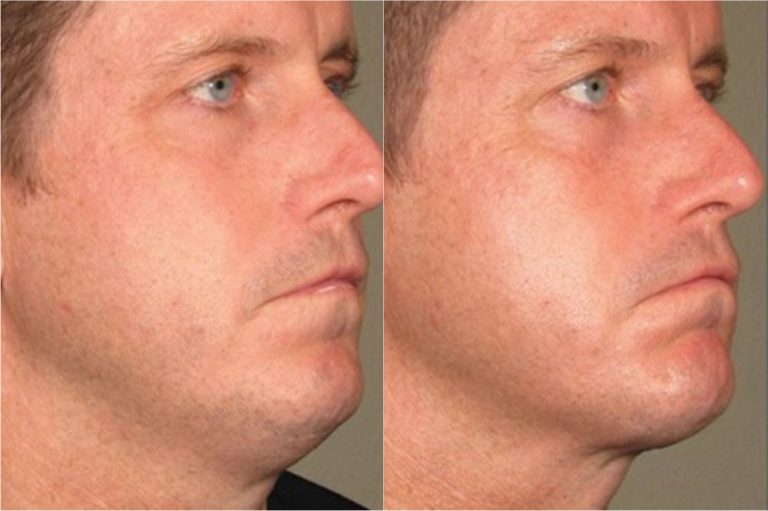 ultherapy-before-after-03