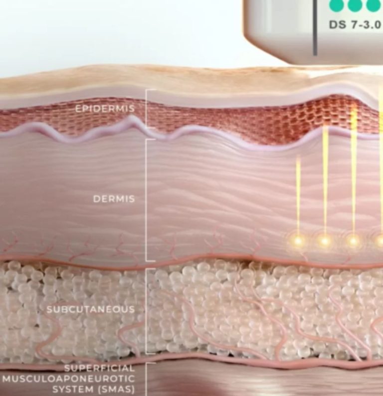 what-is-ultherapy-prime-image-04