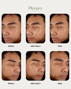 Bring Back Your Clear & Healthy Skin! 💖Say goodbye to acne, dark spots, and inflammation with P (2)